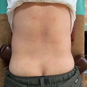 【腰痛・ぎっくり腰には、パルス鍼×骨盤矯正（AKA・SCJM）が根本改善への近道】