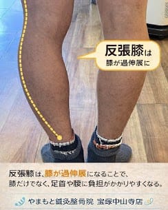 【反張膝が原因？　O脚・膝の痛み・股関節・足首の痛み・腰痛でお悩みの方へ】